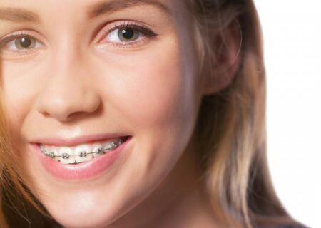 Come l'uso dell'apparecchio dentistico può migliorare la salute dentale a lungo termine