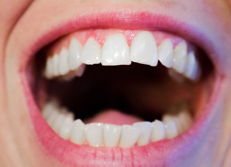 L'apparecchio dentistico: una soluzione efficace per i denti storti