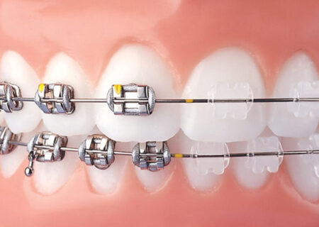 Apparecchio dentistico fisso