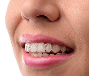 Apparecchio dentistico mobile invisibile