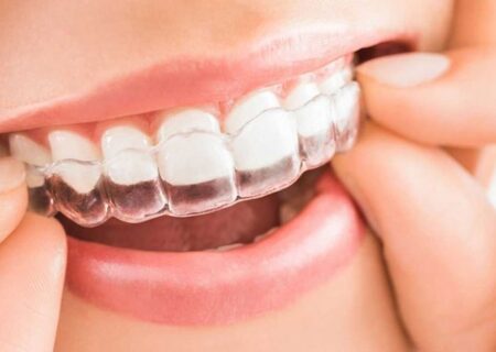Apparecchio dentistico invisibile adulti