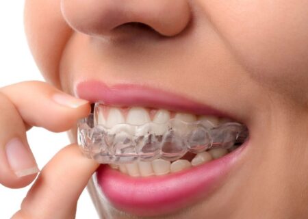 apparecchio dentistico per adulti
